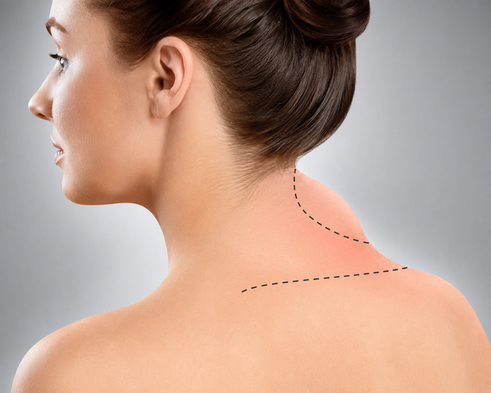 Surgeon consulting a patient about Neck Hump Reduction